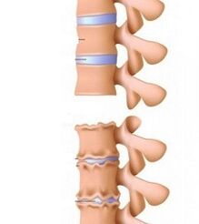 Stage Ramp stages Osteochondrose doors