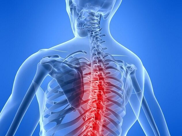 osteochondrosis of the thoracic spine